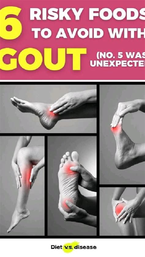 Not just the big toe the most common places gout harms – Artofit