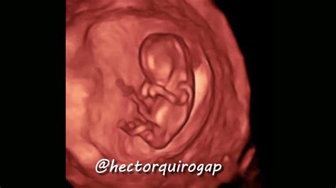 3D ultrasound at 11 weeks of pregnancy - YouTube