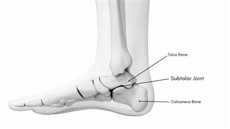 Subtalar Joint Arthritis: explained by a Foot Specialist