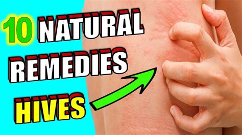 10 Natural Remedies for Skin Hives (TREATMENT AT HOME) - YouTube