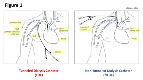 Tunneled Catheter