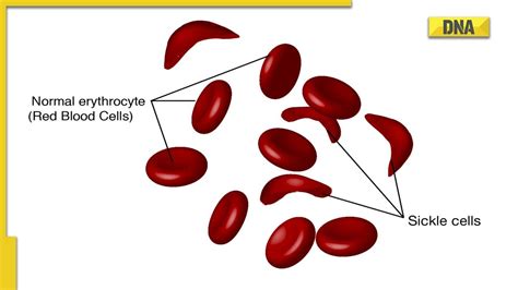 What is sickle cell anemia? Know how this disease will be eliminated by 2047