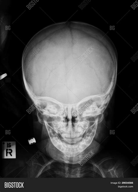Childs Skull X-ray Image & Photo (Free Trial) | Bigstock
