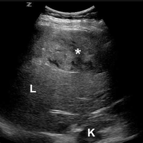 Liver Hematoma Ultrasound