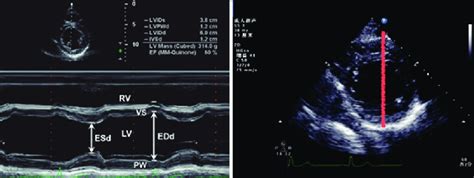 Standard view of ejection fraction measurement (left ventricular... | Download Scientific Diagram