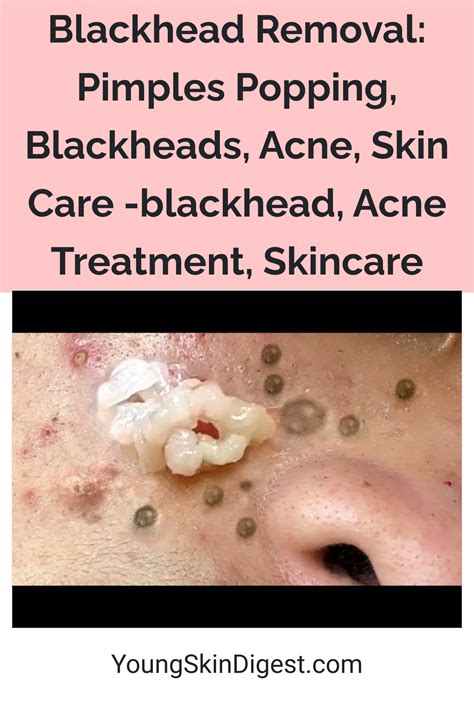 Blackhead Removal: Pimples Popping, Blackheads, Acne, Skin Care ...