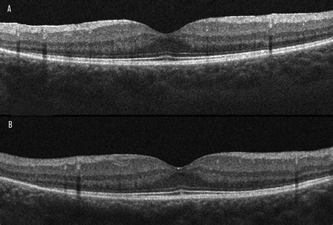 Autoimmune Retinopathy: A Review