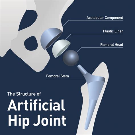 Partial Hip Replacement vs. Total Hip Replacement - USA Spine & Ortho