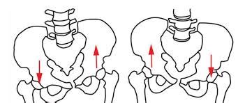 Lateral Pelvic tilt (Left vs Right pelvic tilt): Causes, Treatment