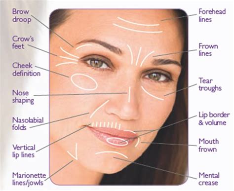 wrinkles | Face fillers, Nasolabial folds, Dermal fillers