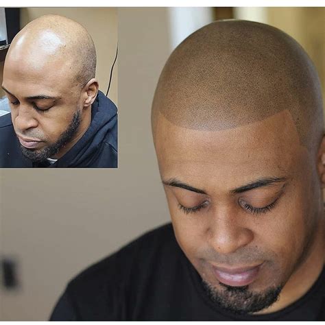 Scalp Micropigmentation Treatments For Men And Women In Maryland