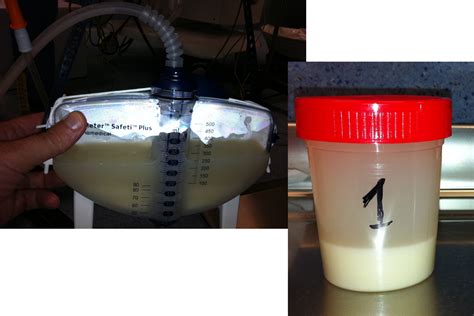 Bronchoalveolar lavage fluid of a patient | International Journal of Clinical & Medical Images