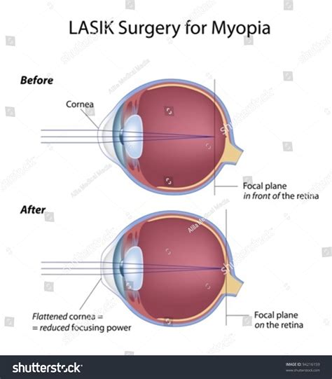 Optometrist: Lasik Eye Surgery