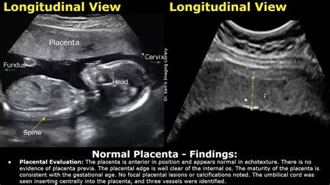 Placenta Ultrasound Reporting | How To Write Pregnancy USG Reports | Pathologies & Positions ...