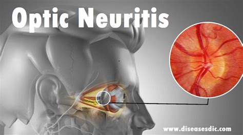 Optic neuritis- Causes, Diagnosis and Management