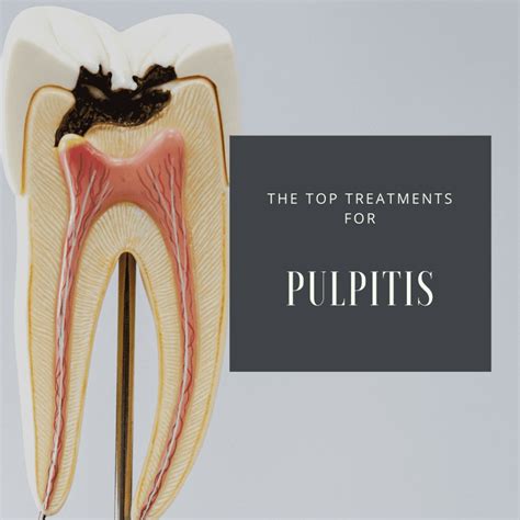 The Top Treatments for Pulpitis | Cromwell Dentists | Fedorciw ...