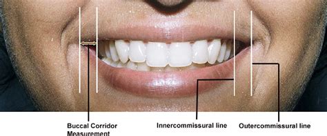 Characterization of posed smile by using visual analog scale, smile arc, buccal corridor ...