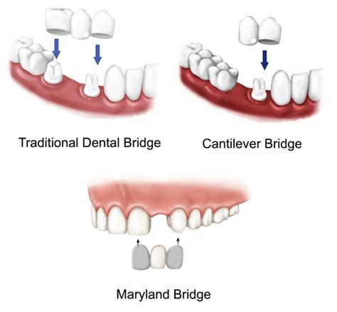 Dental Bridges in Lichfield