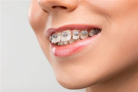 Can I Get Braces with Missing Teeth? - Port Macquarie Dental Centre