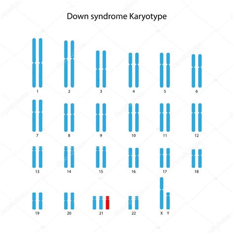 Síndrome de Down (trisomía 21) cariotipo humano 2024