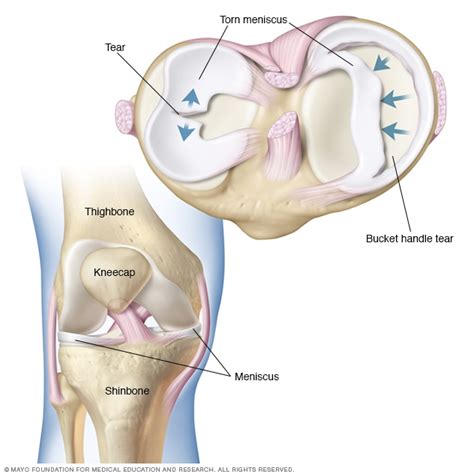 Torn meniscus - Symptoms & causes - Mayo Clinic