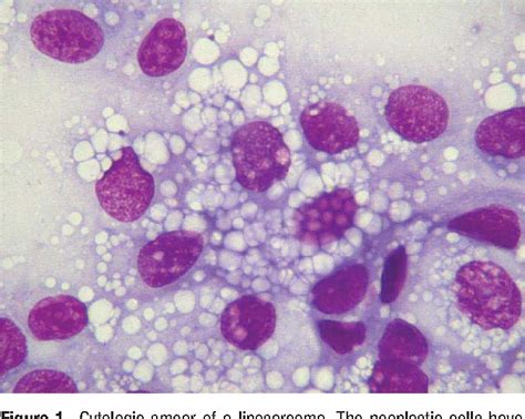 Figure 1 from Use of Oil Red O stain in the cytologic diagnosis of canine liposarcoma ...