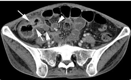 Intestinal tuberculosis in a 52-year-old woman. Coronal com- puted ...