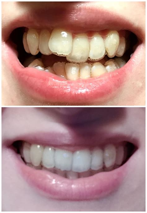 Tray 1 to Retainers (31 trays later - Finally smiling!) : r/Invisalign