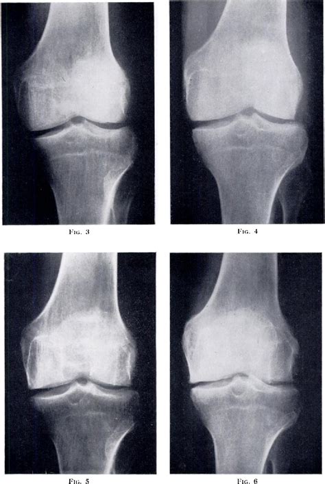 Figure 5 from SYNOVECTOMY OF THE KNEE IN RHEUMATOID ARTHRITIS An Essay in Surgical Salvage ...