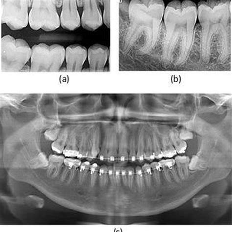 Bitewing radiograph uses - MEDizzy