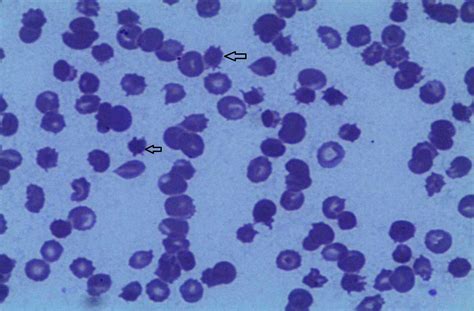 Cureus | Spur Cells Causing Severe and Transfusion-Refractory Anemia in ...