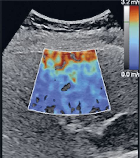 Example of the reverberation artifact from the liver capsule in SWE.... | Download Scientific ...