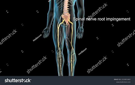 Spinal Nerve Root Impingement 3d Illustration Stock Illustration 2220853465 | Shutterstock