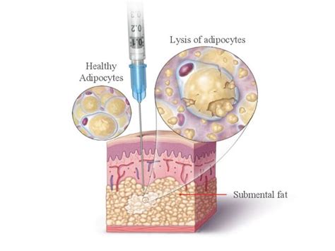 What is Deoxycholic Acid Injection? Uses & Side Effects | MayLips