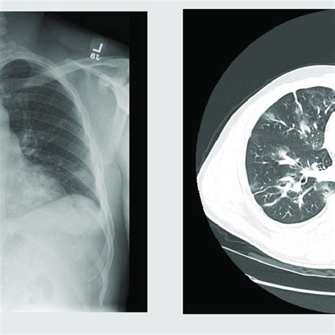 Chest x-ray showing patchy bilateral pulmonary infiltrates Figure 2.... | Download Scientific ...