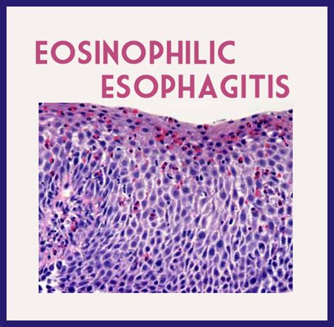 Eosinophilic Esophagitis Causes, Symptoms, Diangosis and Treatment ...