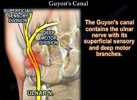 Guyon’s Canal; Ulnar Tunnel Syndrome — OrthopaedicPrinciples.com