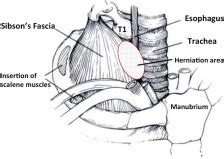 Beyond the boundaries: Surgical repair of apical parietal pleural hernia - The Journal of ...