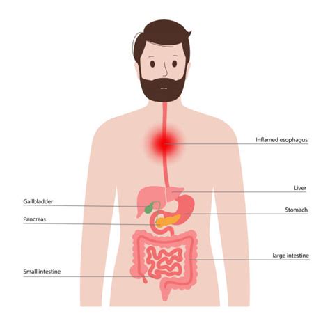 Esophageal Cancer Surgery Stock Photos, Pictures & Royalty-Free Images - iStock