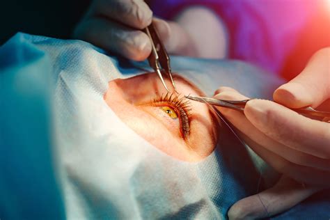 What Makes Suture Relevant in Ophthalmic Surgery in the Age of Lasers ...