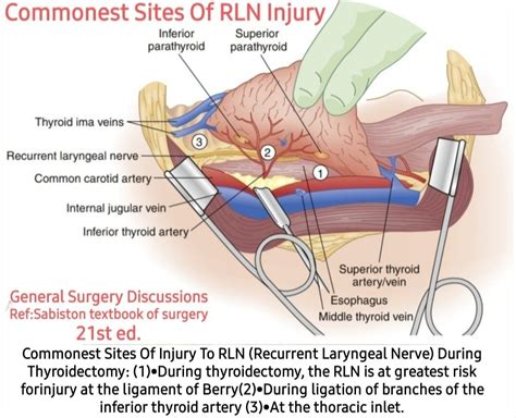 Recurrent Laryngeal Nerve In Thyroidectomy