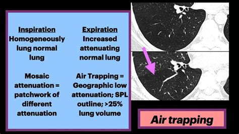 Air Trapping #radiology #pulmonology #asthma - YouTube