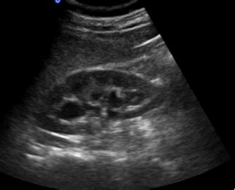 CT Versus Ultrasound for Kidney Stones - emdocs