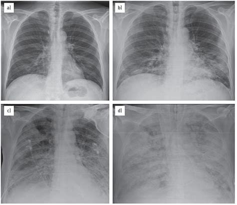 UPDATE - Wave of pneumonia hits US: Ohio county records 142 child cases ...