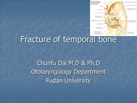 PPT - Fracture of temporal bone PowerPoint Presentation, free download ...