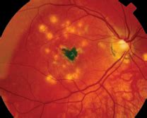 Multifocal Choroiditis vs. PIC: Variations on a Theme?