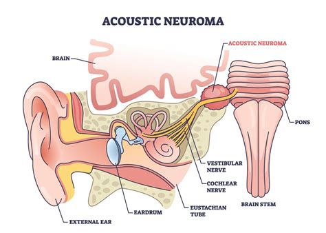 Vestibular Schwannoma Tumors | Advocate Health Care