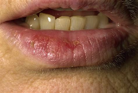 👉 Sunburned Lips - Pictures, Symptoms, Treatment, Causes (December 2021)