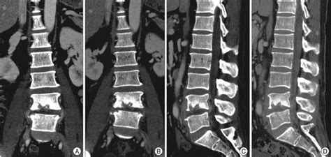 Tuberculosis of Bones