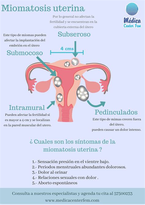 Miomatosis Uterina : sintomas, causas y tratamiento | Obstetricia y puericultura, Gineco ...